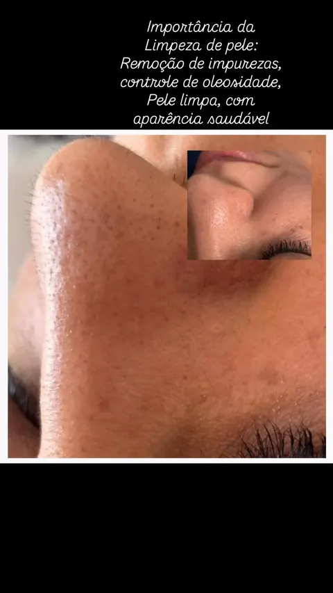 Frame real do vídeo sobre limpeza de pele, com imagens aproximadas da textura da pele.